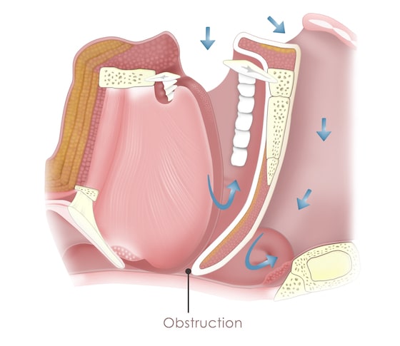 obstructive-sleep-apnea-min