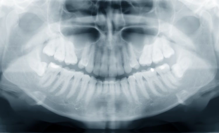 xray-min